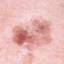 36. Early Melanoma Pictures