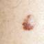 40. Early Melanoma Pictures