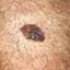 42. Early Melanoma Pictures