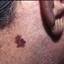 43. Early Melanoma Pictures
