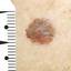 44. Early Melanoma Pictures