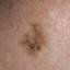 6. Early Melanoma Pictures