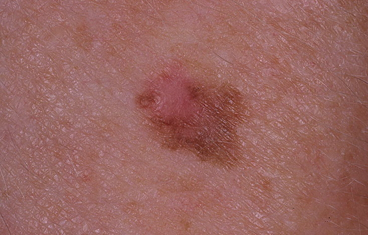 Early Melanoma Pictures 54 Photos And Images