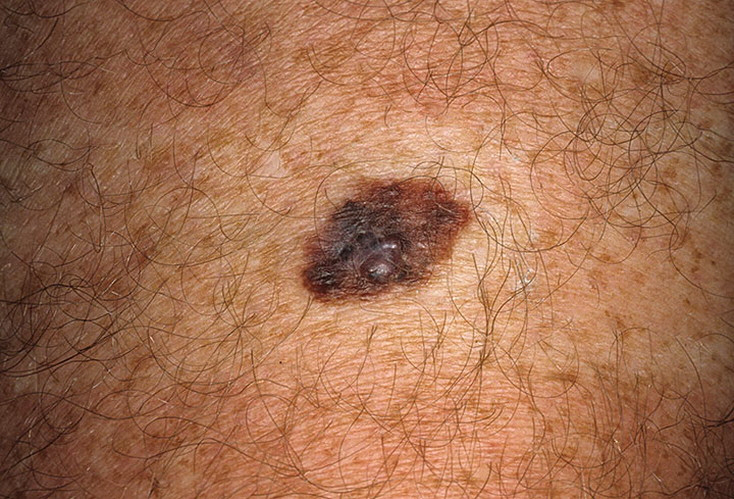 early-melanoma-pictures-54-photos-images-illnessee