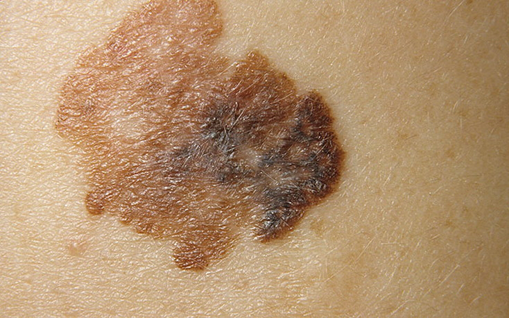 Early Melanoma Pictures – 54 Photos & Images / illnessee.com
