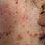 1. Chicken Pox Virus Pictures