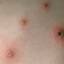 21. Chicken Pox Virus Pictures