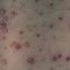 32. Chicken Pox Virus Pictures
