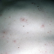 Adult Chicken Pox Symptoms