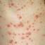 14. Adult Chicken Pox Symptoms Pictures