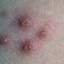 19. Adult Chicken Pox Symptoms Pictures