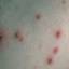 24. Adult Chicken Pox Symptoms Pictures