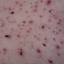 27. Adult Chicken Pox Symptoms Pictures
