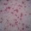 28. Adult Chicken Pox Symptoms Pictures