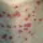 3. Adult Chicken Pox Symptoms Pictures