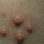 30. Adult Chicken Pox Symptoms Pictures