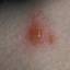 31. Adult Chicken Pox Symptoms Pictures