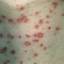 33. Adult Chicken Pox Symptoms Pictures