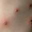 35. Adult Chicken Pox Symptoms Pictures