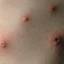 38. Adult Chicken Pox Symptoms Pictures