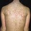 39. Adult Chicken Pox Symptoms Pictures