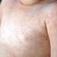 10. Symptoms of Rubella in Children Pictures