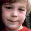6. Symptoms of Rubella in Children Pictures