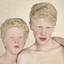 10. Albinism in humans Pictures