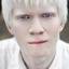 20. Albinism in humans Pictures