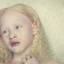 24. Albinism in humans Pictures