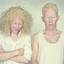 26. Albinism in humans Pictures