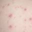 7. Start of Chickenpox Pictures