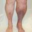 1. Thrombosis leg Pictures