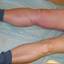 10. Thrombosis leg Pictures