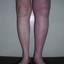 19. Thrombosis leg Pictures