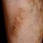 23. Thrombosis leg Pictures