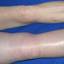 28. Thrombosis leg Pictures