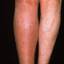 3. Thrombosis leg Pictures