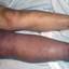 30. Thrombosis leg Pictures