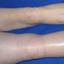 7. Thrombosis leg Pictures