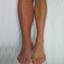 8. Thrombosis leg Pictures