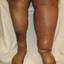 9. Thrombosis leg Pictures