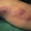 11. Thrombosis Symptoms Leg Pictures