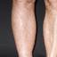 13. Thrombosis Symptoms Leg Pictures
