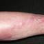14. Thrombosis Symptoms Leg Pictures