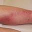 15. Thrombosis Symptoms Leg Pictures