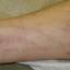 18. Thrombosis Symptoms Leg Pictures
