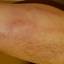 20. Thrombosis Symptoms Leg Pictures