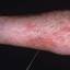 24. Thrombosis Symptoms Leg Pictures