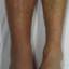 27. Thrombosis Symptoms Leg Pictures